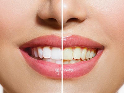 Closeup of woman’s smile halved to show results of teeth whitening