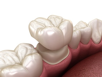 A single dental crown