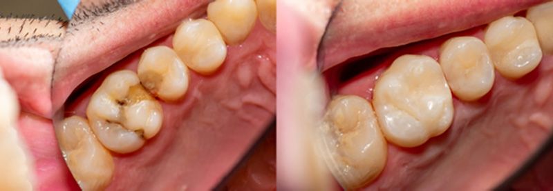 Before and after images of a tooth with and without a crown  