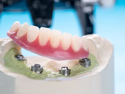 Example of Implant dentures in Rochester
