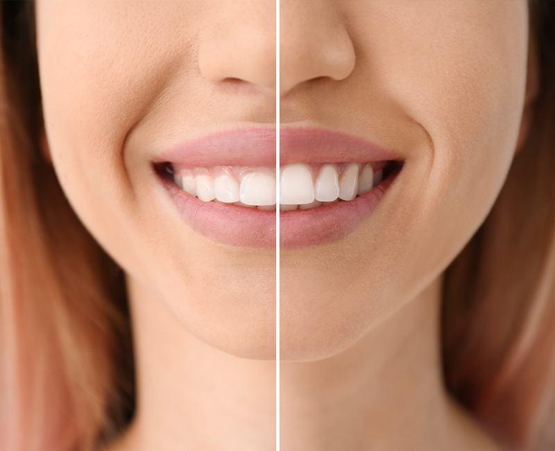 Smile before and after gum recontouring