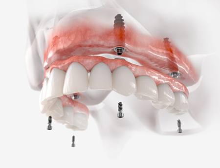 Light-colored digital image of fixed implant denture