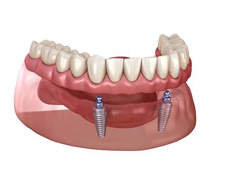 Illustration of ball-retained implant denture