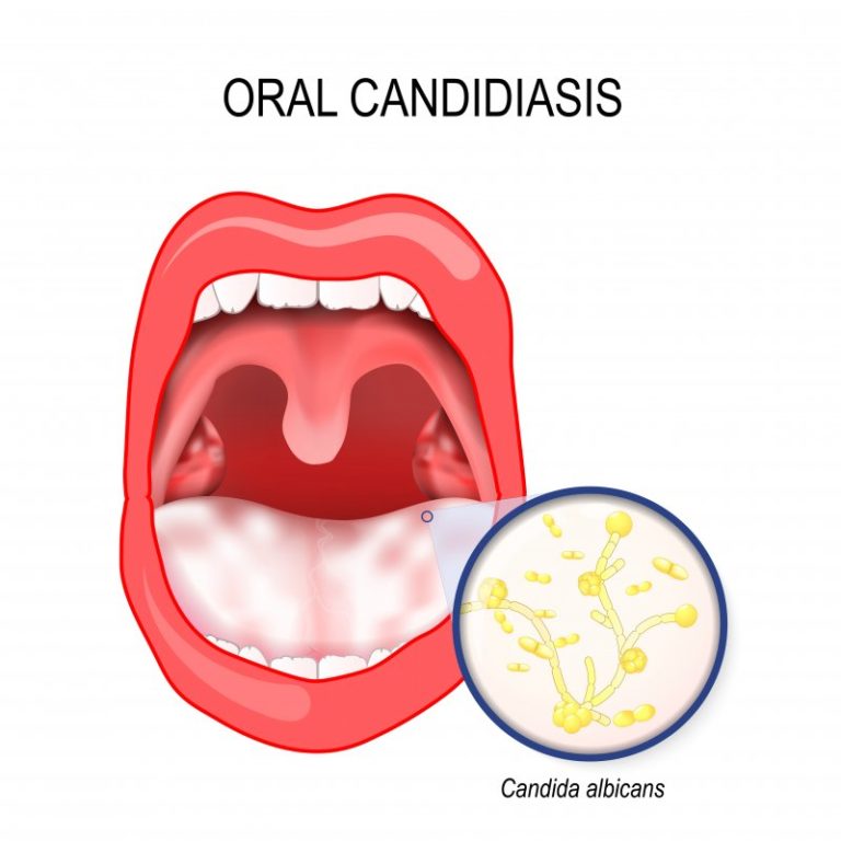 what-is-the-white-film-in-my-mouth-rochester-zumbro-family-dental